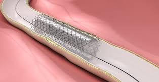 Non-Vascular Stents