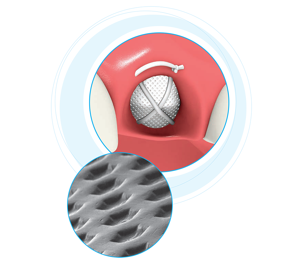 Non-resorbable PTFE Membranes