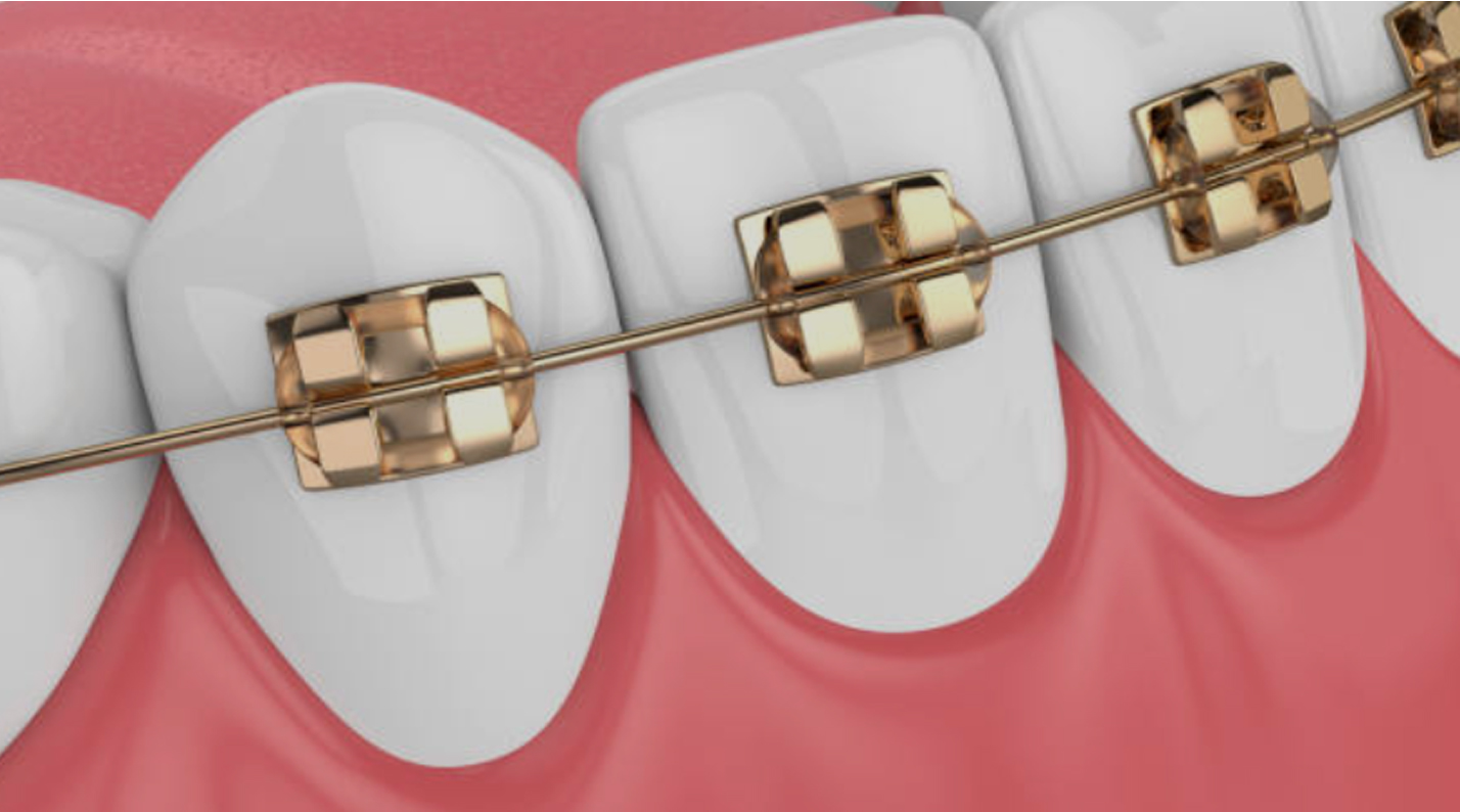 Orthodontic Archwire and Bracket Market