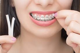 Orthodontic Consumables