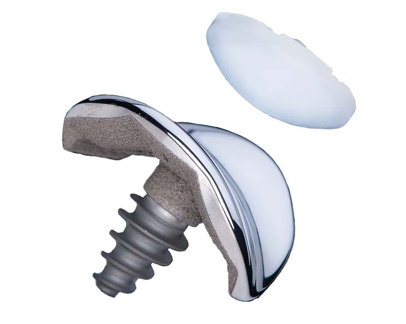 Patellofemoral Arthroplasty System