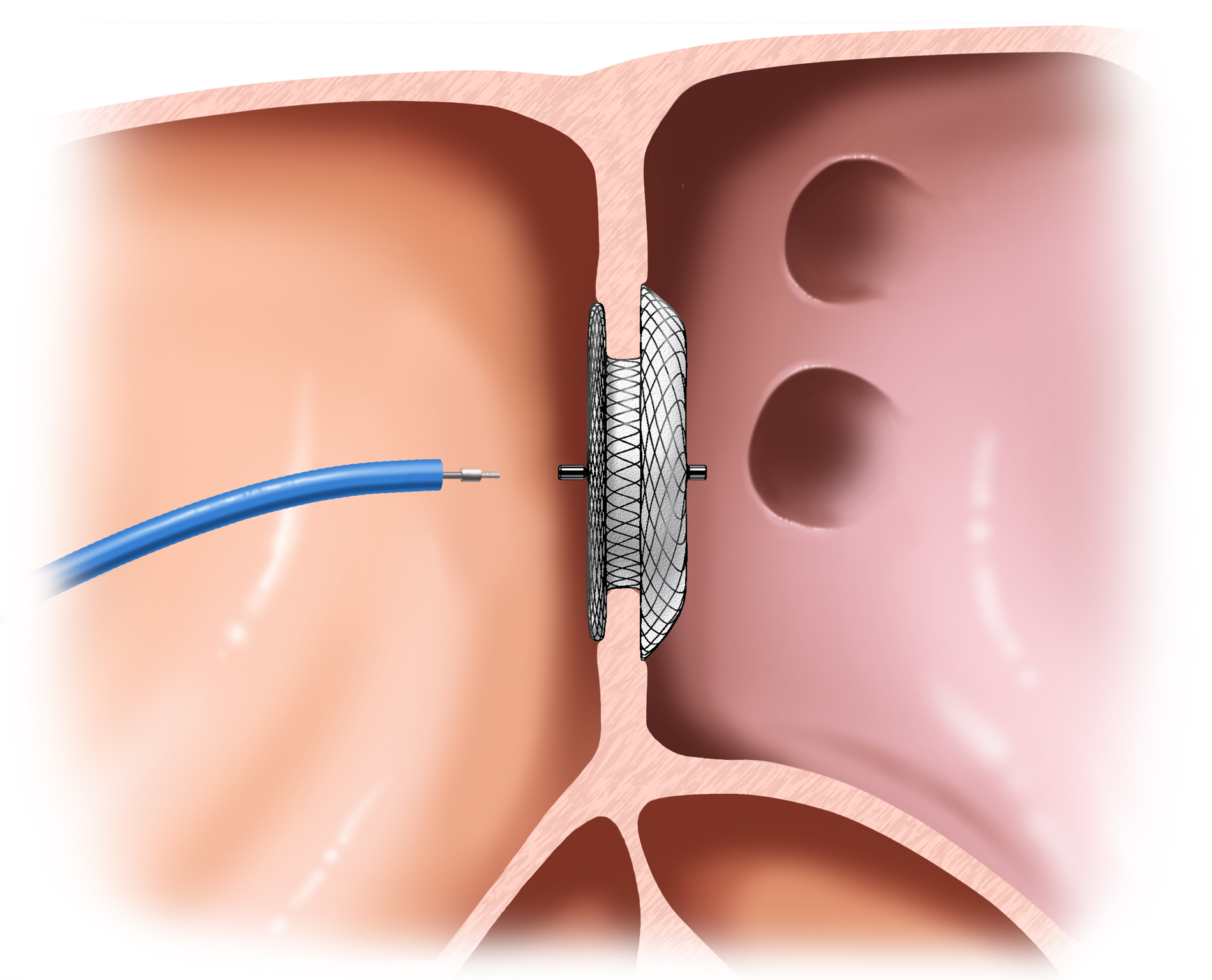 Patent Foramen Ovale Closure Device