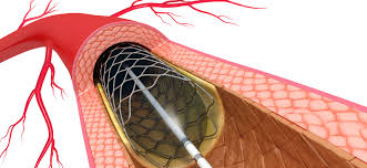 Percutaneous Coronary Intervention Guidance Devices