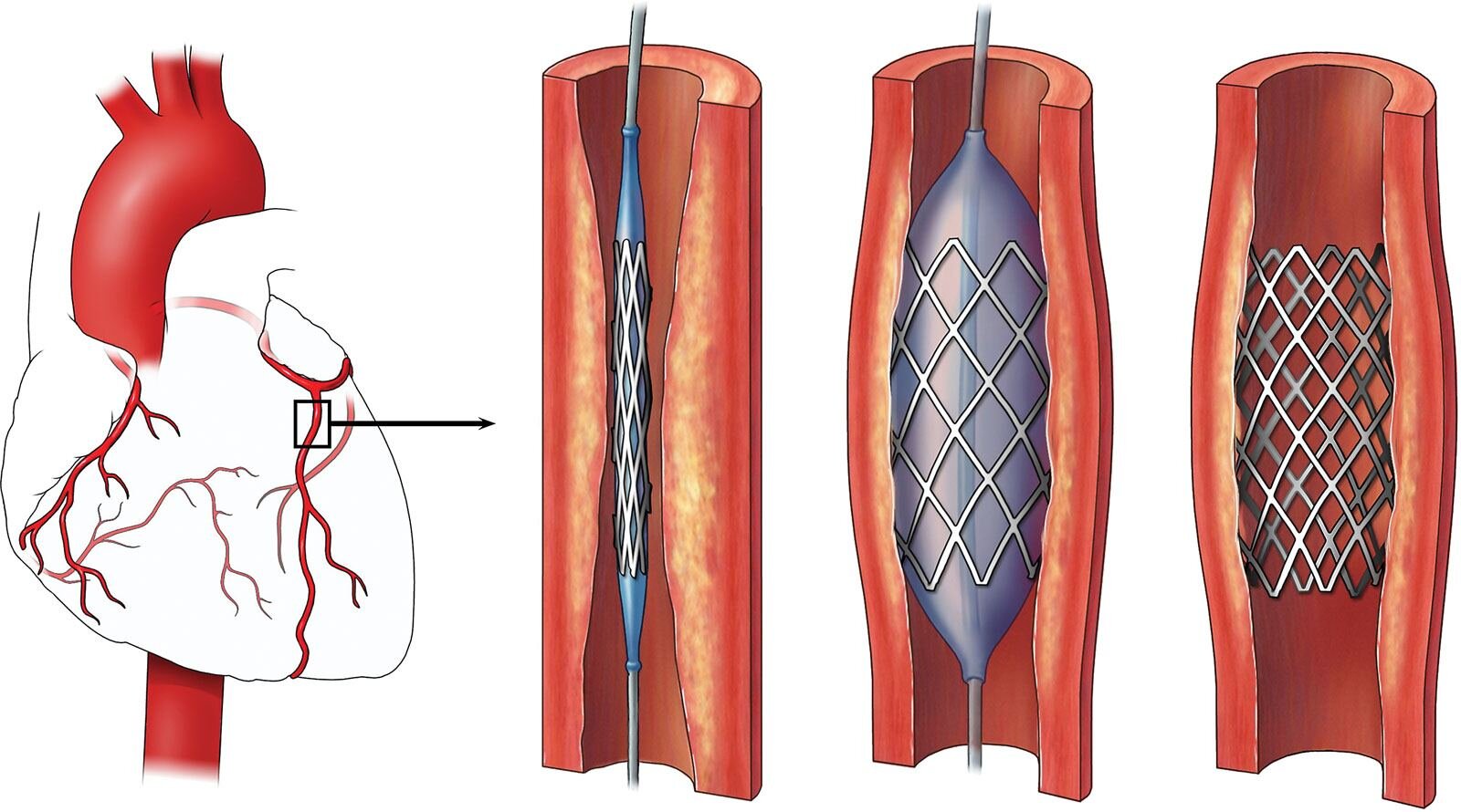 Percutaneous Coronary Intervention (PCI) Devices