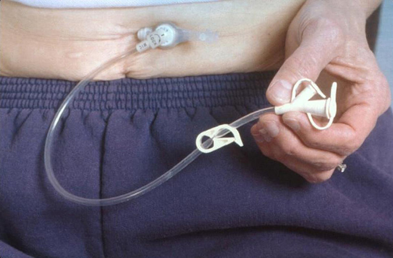 Percutaneous Endoscopic Gastrostomy (PEG) Tube