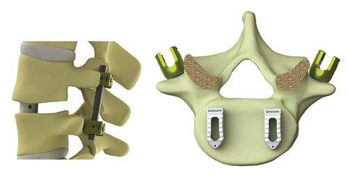 Polyether Ether Ketone (PEEK) Interbody Devices