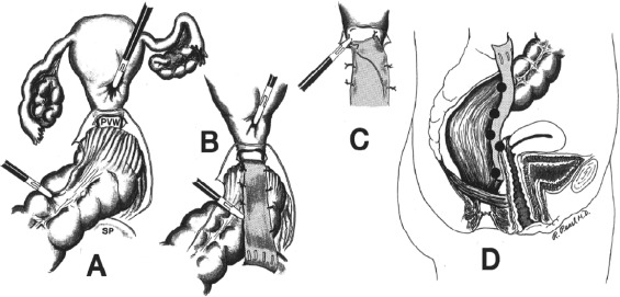 Rectopexy Mesh and Graft Market