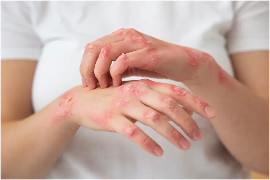 Scabies Treatment