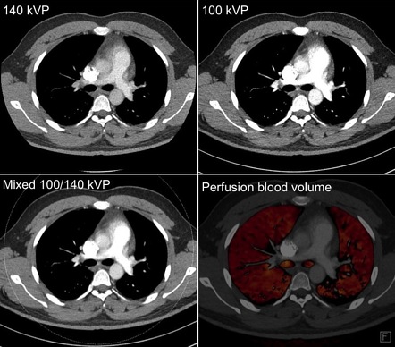 Spectral Computed Tomography