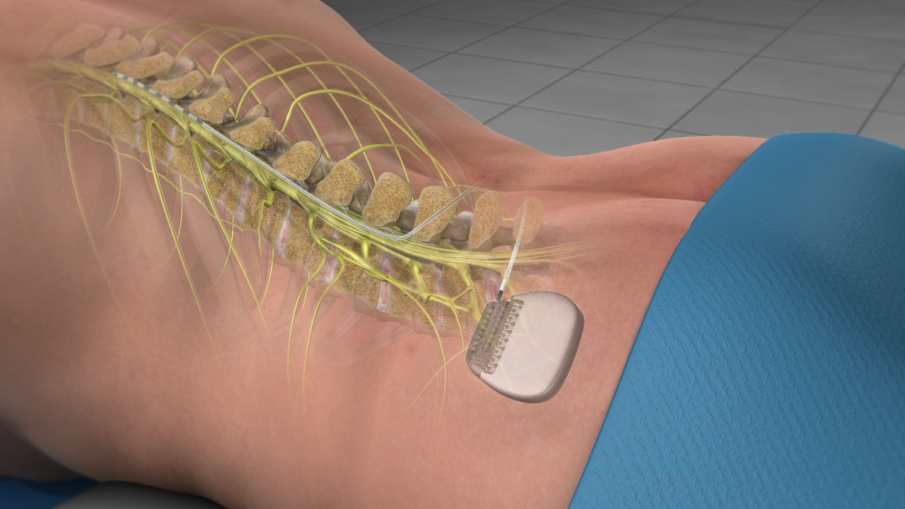 Spinal Cord Stimulation Devices