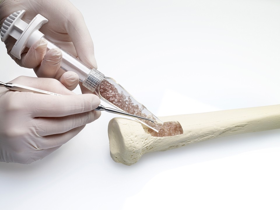 Spine Bone Graft Substitute