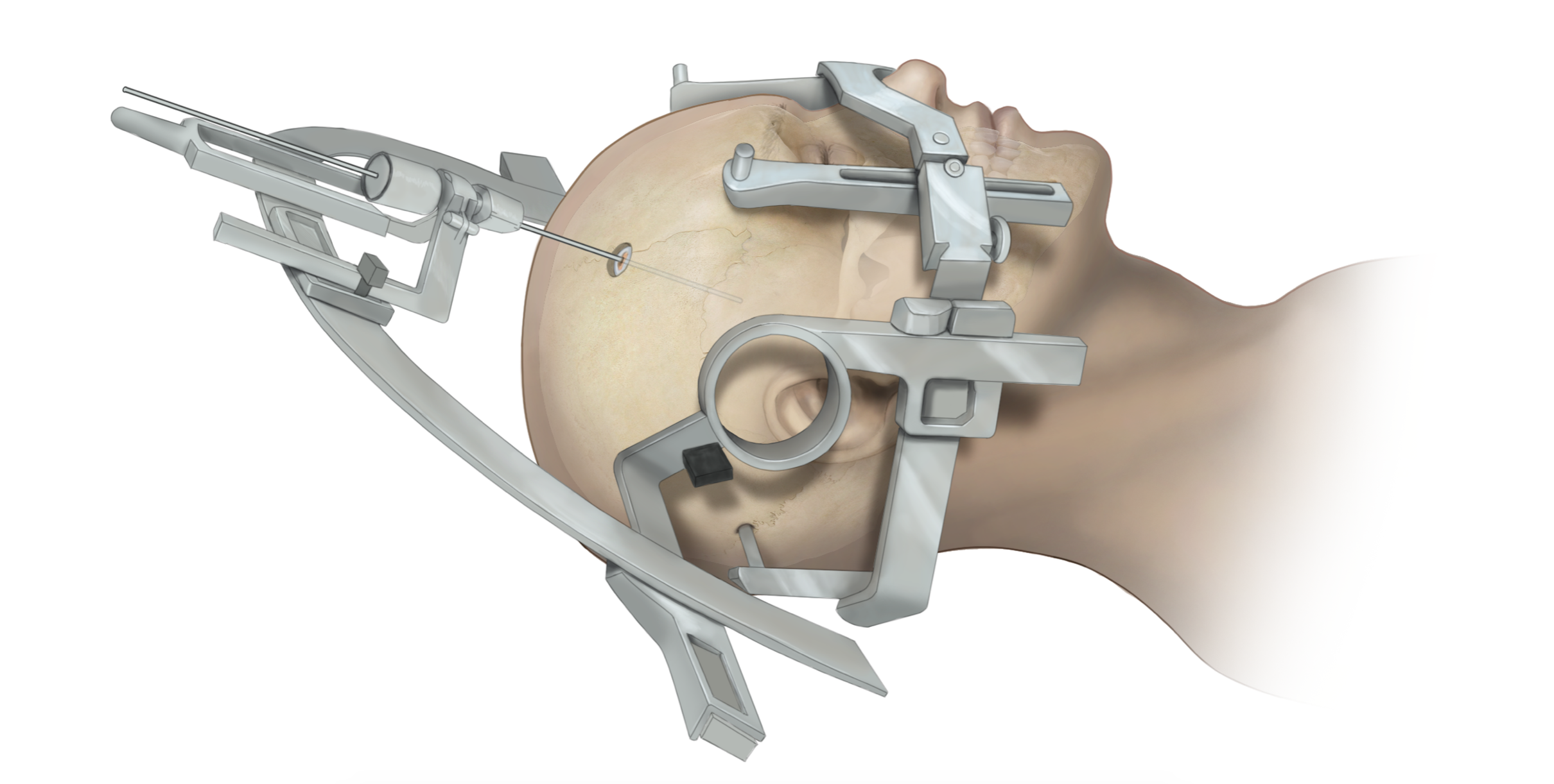 Stereotactic Surgery Devices Market