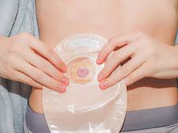 Stoma/Ostomy Care