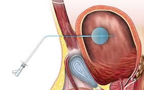 Suprapubic Catheter market