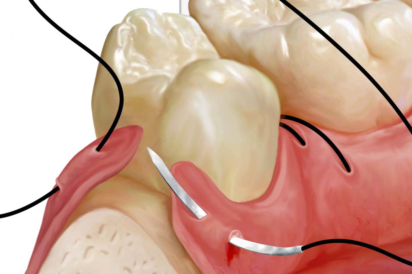 Suture Materials in Dentistry