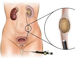 Ureteroscopy