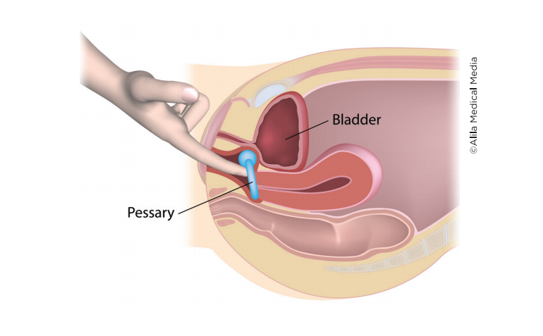 Vaginal Pessary