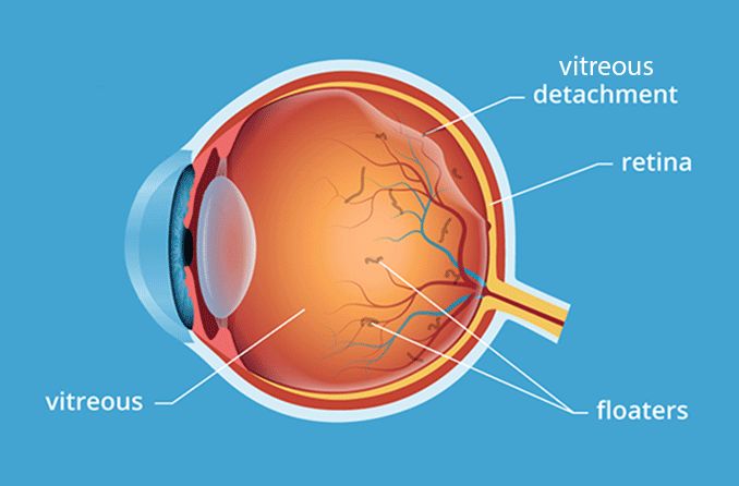 Vitreous Detachment Treatment