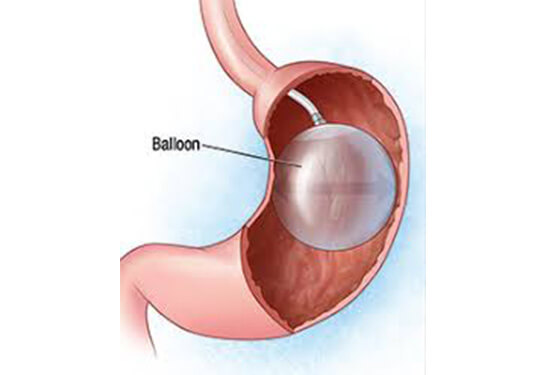 Weight-loss Use Intragastric Balloon