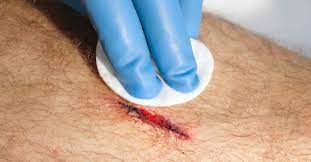 Wound Drainage