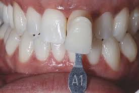 Zirconia-Based Porcelain Veneer market